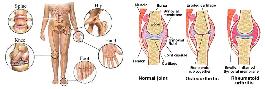 Arthritis Osteoarthritis 