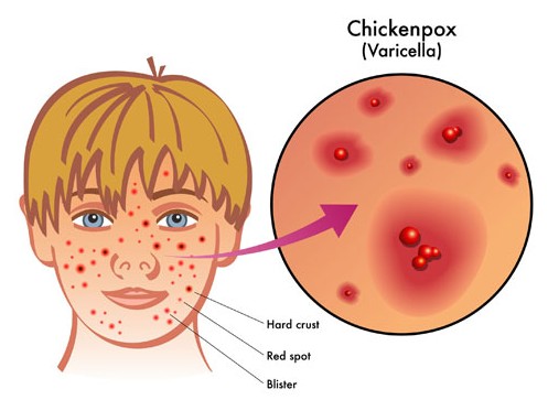 Chickenpox