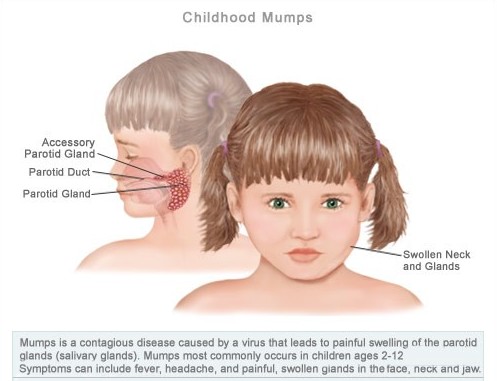 Mumps